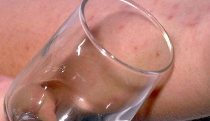 Μηνιγγίτιδα – Σημάδι στο δέρμα: Πώς γίνεται επιτόπου το “τεστ με το ποτήρι”
