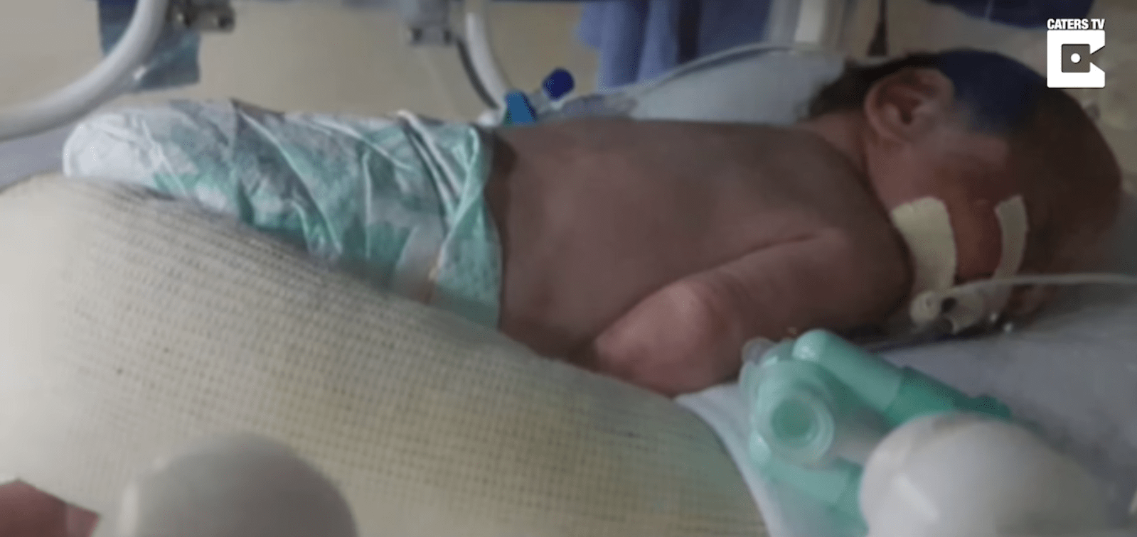 Εγκεφαλικά νεκρή μητέρα κρατήθηκε ζωντανή για 123 μέρες μέχρι που γέννησε δυο υγιέστατα δίδυμα