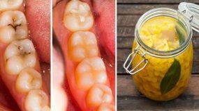 Πως να θεραπεύσετε την τερηδόνα και τις "κουφάλες" στα δόντια με φυσικό τρόπο: 3 απλές και αποτελεσματικές θεραπείες