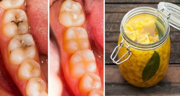 Πως να θεραπεύσετε την τερηδόνα και τις "κουφάλες" στα δόντια με φυσικό τρόπο: 3 απλές και αποτελεσματικές θεραπείες