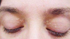Πώς να αφαιρέσετε αυτές τις κίτρινες κηλίδες που βρίσκονται γύρω από τα μάτια σας;
