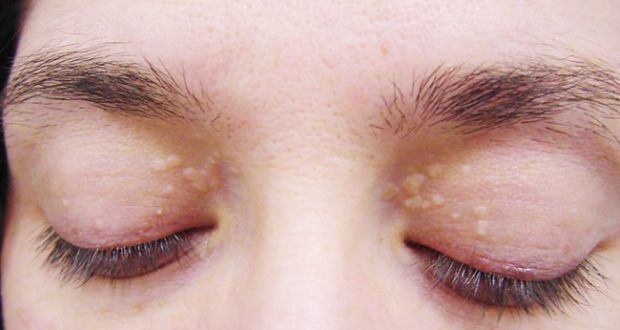 Πώς να αφαιρέσετε αυτές τις κίτρινες κηλίδες που βρίσκονται γύρω από τα μάτια σας;