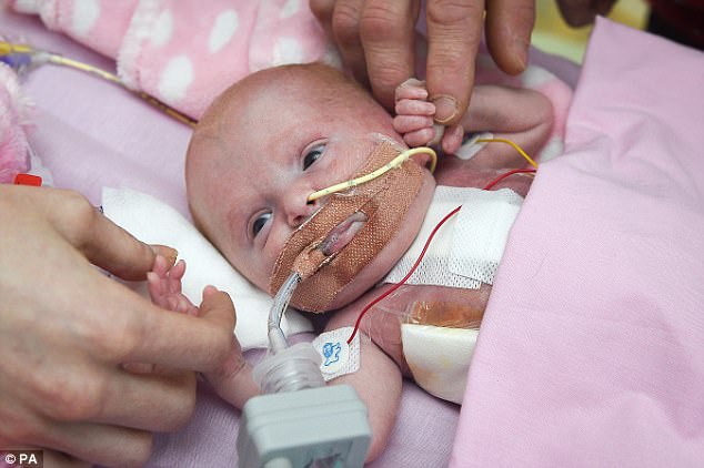 Πρόωρο μωρό γεννήθηκε με την καρδιά του έξω και είναι το πρώτο που επιβίωσε παγκοσμίως