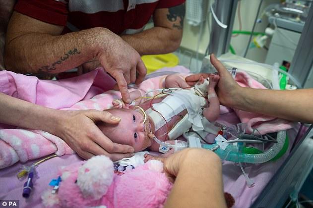 Πρόωρο μωρό γεννήθηκε με την καρδιά του έξω και είναι το πρώτο που επιβίωσε παγκοσμίως