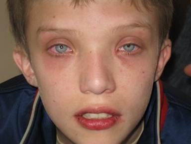 Λοίμωξη από αδενοϊό στο παιδί: Συμπτώματα, κίνδυνοι και θεραπεία
