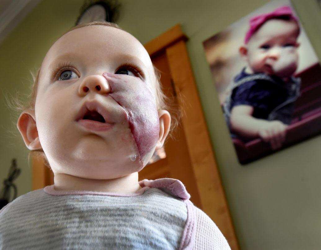 Μικρό κοριτσάκι που γεννήθηκε με ένα τεράστιο όγκο στο πρόσωπο μεταμορφώνεται εντελώς χάρη σε μια ομάδα αφοσιωμένων γιατρών