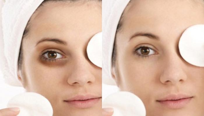 DIY: Απαλλαγείτε από τους μαύρους κύκλους με αυτό το απίστευτα αποτελεσματικό γαλάκτωμα ματιών DIY: Απαλλαγείτε από τους μαύρους κύκλους με αυτό το απίστευτα αποτελεσματικό γαλάκτωμα ματιών
