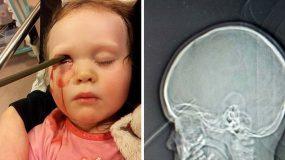 Απίστευτη τύχη είχε αυτό το μωρό που επιβίωσε από μολύβι που τρύπησε το μάτι και τον εγκέφαλό της ενώ έπαιζε