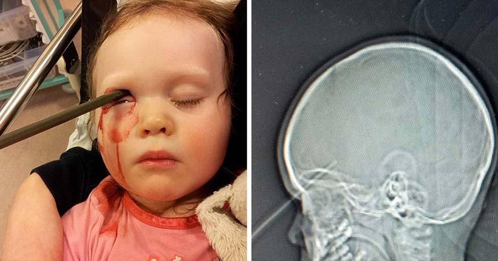 Απίστευτη τύχη είχε αυτό το μωρό που επιβίωσε από μολύβι που τρύπησε το μάτι και τον εγκέφαλό της ενώ έπαιζε