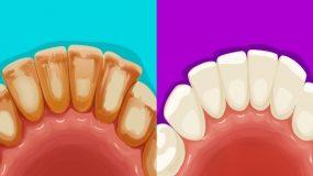 Έχετε κίτρινα δόντια; Απαλλαγείτε από αυτά με αποτελεσματικές σπιτικές θεραπείες