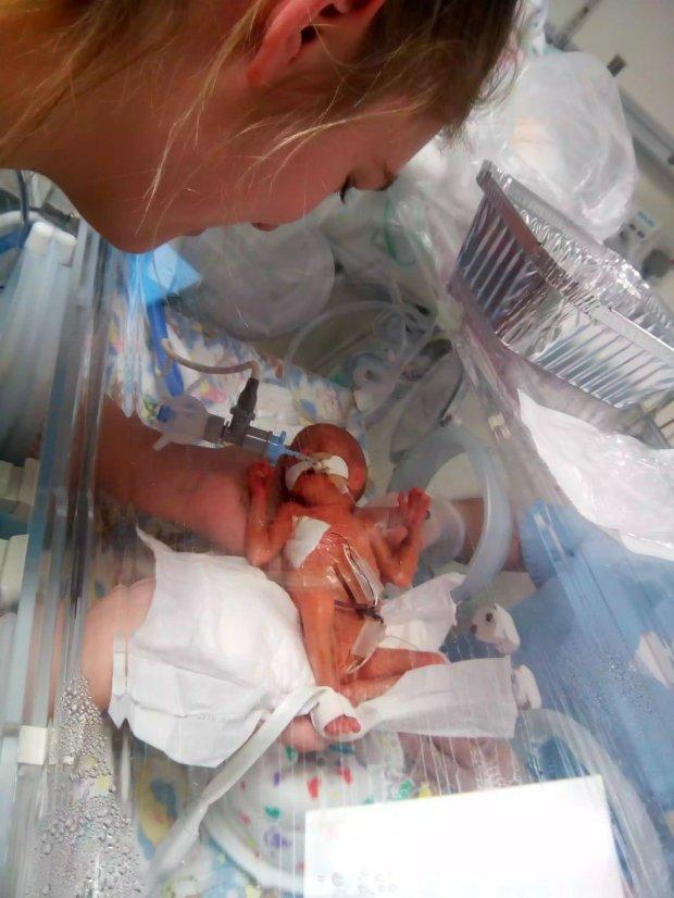 Η γέννηση αυτού του μωρού ήταν τόσο πρόωρη που ο εγκέφαλος του φαινόταν στο δέρμα του