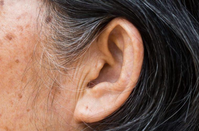 Εάν έχετε αυτό το σημάδι στο αυτί σας, μπορεί να κινδυνεύετε από εγκεφαλικό
