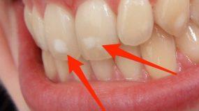 Έχετε και εσείς αυτές τις λευκές κηλίδες στα δόντια; Δείτε που οφείλονται και τι πρέπει να κάνετε!