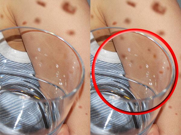 Μηνιγγίτιδα – Σημάδι στο δέρμα: Πώς γίνεται επιτόπου το έξυπνο «τεστ με το ποτήρι»(vid)