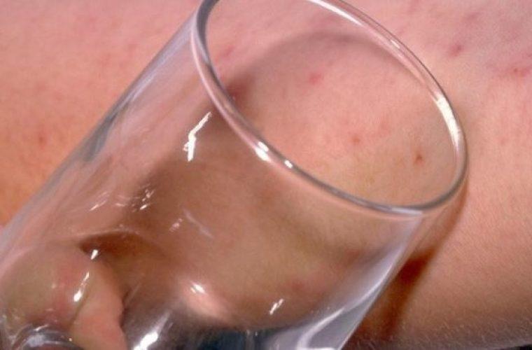 Μηνιγγίτιδα – Σημάδι στο δέρμα: Πώς γίνεται επιτόπου το έξυπνο «τεστ με το ποτήρι»(vid)