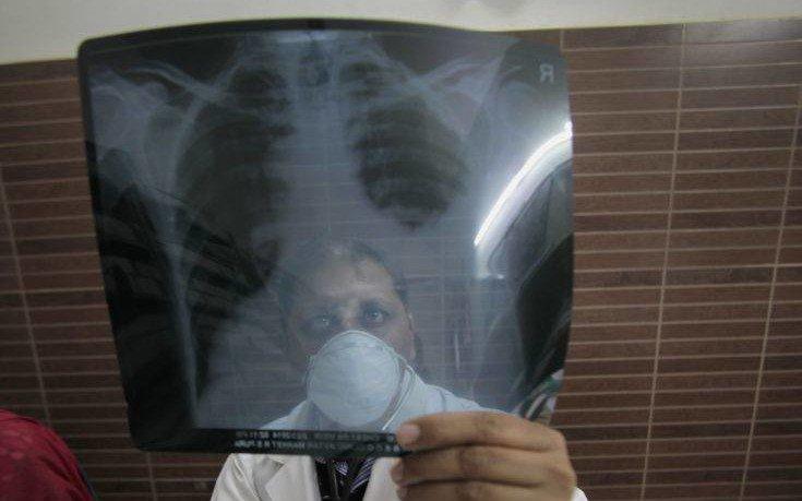 Οι επιστήμονες τονίζουν οτι η φυματίωση είναι παρούσα στην Ελλάδα!