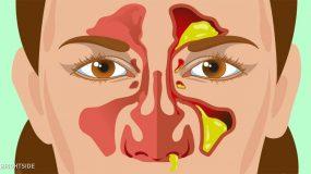 9 Διαφορετικοί τύποι εκκριμάτων της μύτης και τι δείχνουν για την υγεία μας;