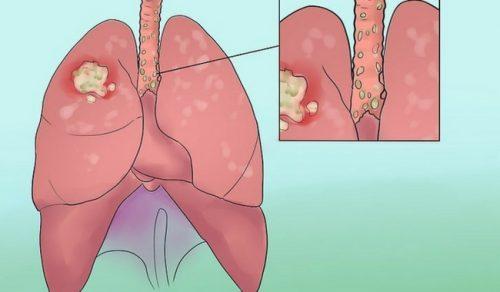 8 σοκαριστικά σημάδια του καρκίνου του πνεύμονα που δεν πρέπει να αγνοήσετε