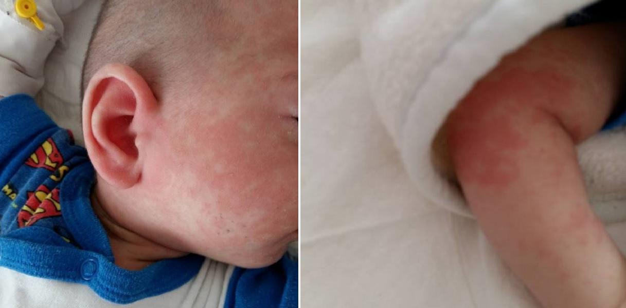 «Αγαπητοί αντιεμβολιαστές» – Το αιχμηρό μήνυμα μιας μητέρας που το 6 μηνών μωρό της νοσεί από ιλαρά
