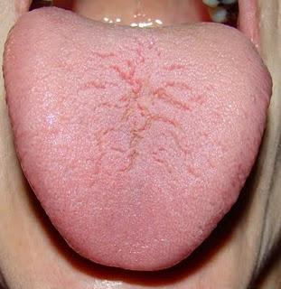 Βρες έναν καθρέφτη και κοίτα τη γλώσσα σου. Αν είναι έτσι πρέπει να πας αμέσως σε γιατρό!