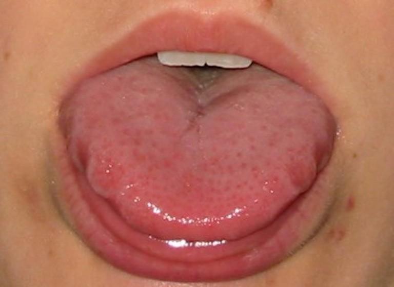 Βρες έναν καθρέφτη και κοίτα τη γλώσσα σου. Αν είναι έτσι πρέπει να πας αμέσως σε γιατρό!