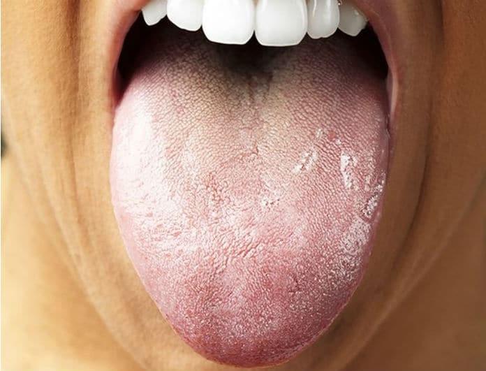 Βρες έναν καθρέφτη και κοίτα τη γλώσσα σου. Αν είναι έτσι πρέπει να πας αμέσως σε γιατρό!