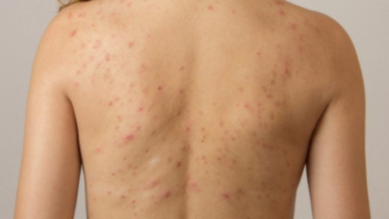 Τι να κάνετε για τα σπυράκια στην πλάτη λόγω ζέστης και ιδρώτα το καλοκαίρι