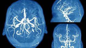 Ανεύρυσμα εγκεφάλου: Τα συμπτώματα καμπανάκια που πρέπει να γνωρίζετε
