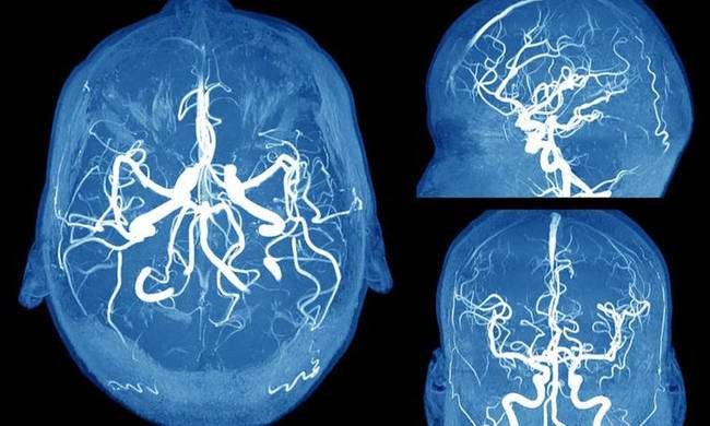 Ανεύρυσμα εγκεφάλου: Τα συμπτώματα καμπανάκια που πρέπει να γνωρίζετε