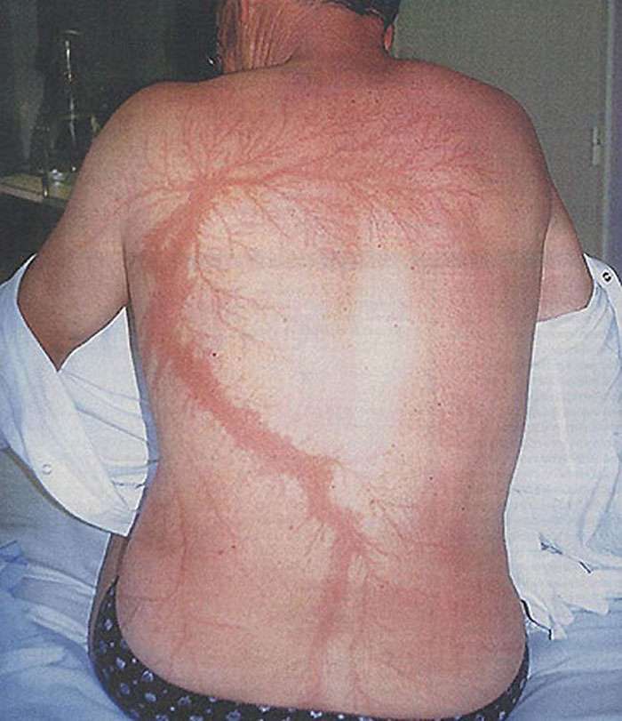Ανθρωποι που τους χτύπησε κεραυνός δείχνουν τα μοναδικά σημάδια στο σώμα τους