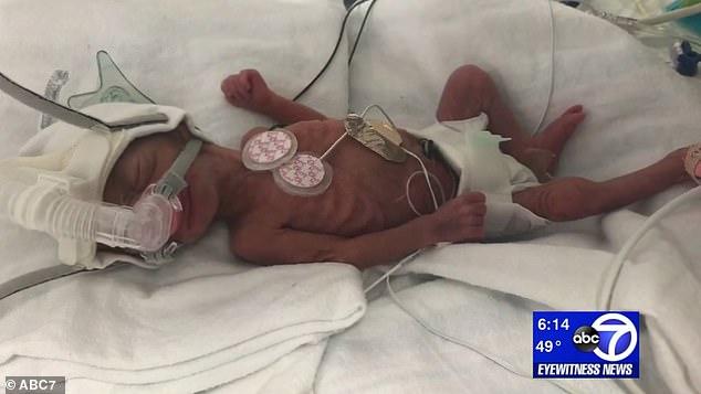 Μωρό – θαύμα που γεννήθηκε 6 μηνών και ζύγιζε μισό κιλό κατάφερε να ζήσει και βγαίνει επιτέλους από το νοσοκομείο