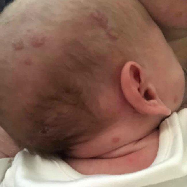 Νεογέννητο μωράκι κινδύνευσε να χάσει τη ζωή του από έρπητα
