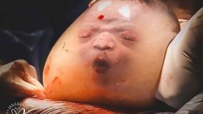 Μία φορά στις 100.000: Μητέρα γέννησε το παιδί της μέσα στον αμνιακό σάκο – Σπάνιες εικόνες