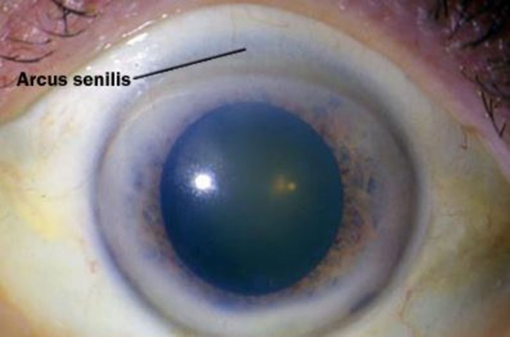Υψηλή χοληστερίνη: Τα σημάδια στα μάτια που δείχνουν ανεβασμένη χοληστερόλη (εικόνες)