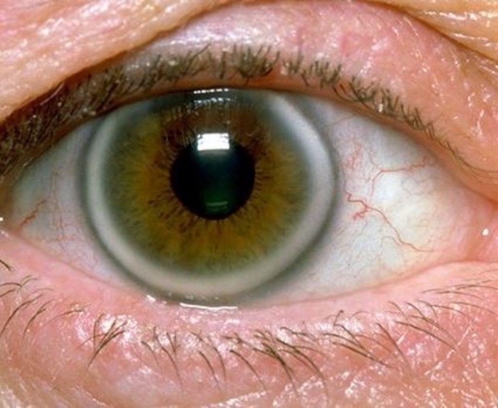 Υψηλή χοληστερίνη: Τα σημάδια στα μάτια που δείχνουν ανεβασμένη χοληστερόλη (εικόνες)