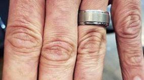 Απέκτησε ξανά τα δάχτυλά του μέσω… τατουάζ -Το αποτέλεσμα είναι εκπληκτικό (εικόνα)