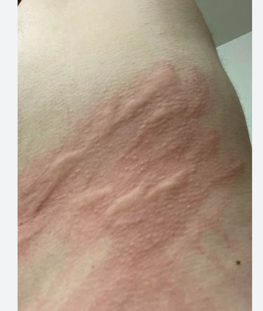 εξανθήματα-στο-δέρμα-