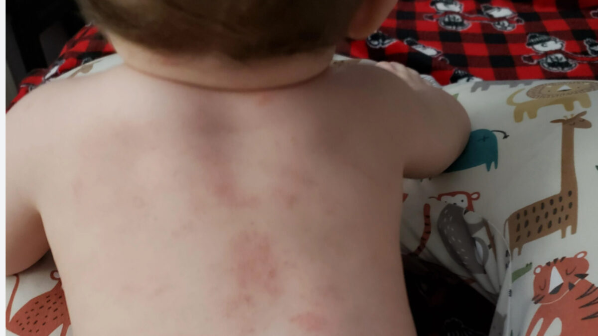 Ανοιξιάτικη δερματίτιδα από κάμπιες: Διάγνωση και τρόποι προστασίας