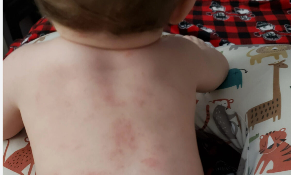 Ανοιξιάτικη δερματίτιδα από κάμπιες: Διάγνωση και τρόποι προστασίας