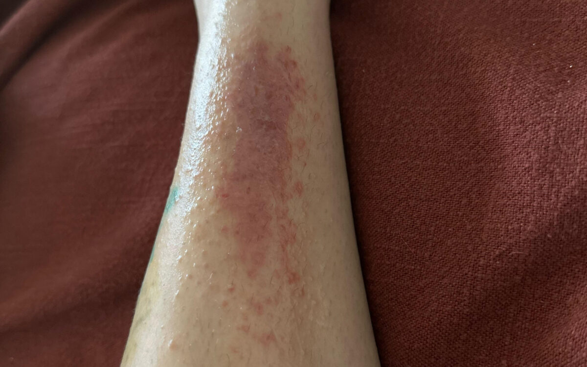 Έχετε αυξημένο στρες; Δείτε 5 δερματικές παθήσεις που μπορεί να προκαλέσει