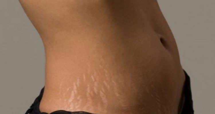 ραγαδες πως να τις απομακρύνετε