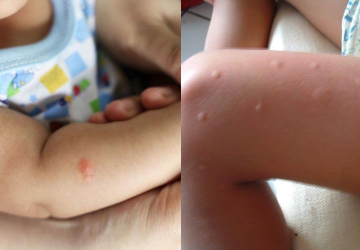 10 λόγοι που σας τσιμπάνε τα κουνούπια! Τον 6ο δεν τον περιμέναμε