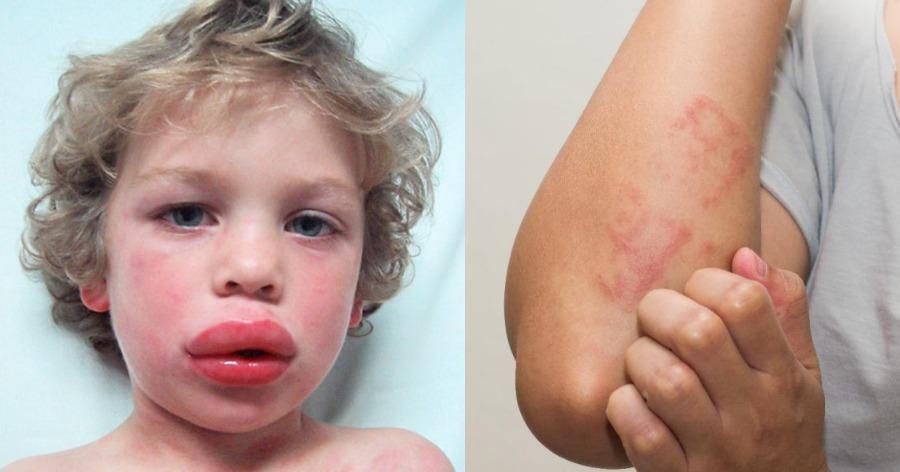 Αναφυλαξία και αλλεργικό επεισόδιο: Δείτε τα συμπτώματα και πως να κάνετε την ένεση αδρεναλίνης