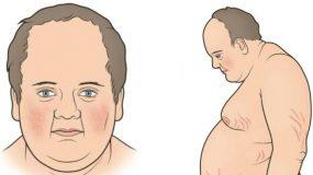 Σύνδρομο Cushing: Η νόσος που διακρίνεται από την αύξηση βάρους και την εύκολη κόπωση- Δείτε όλα τα συμπτώματα