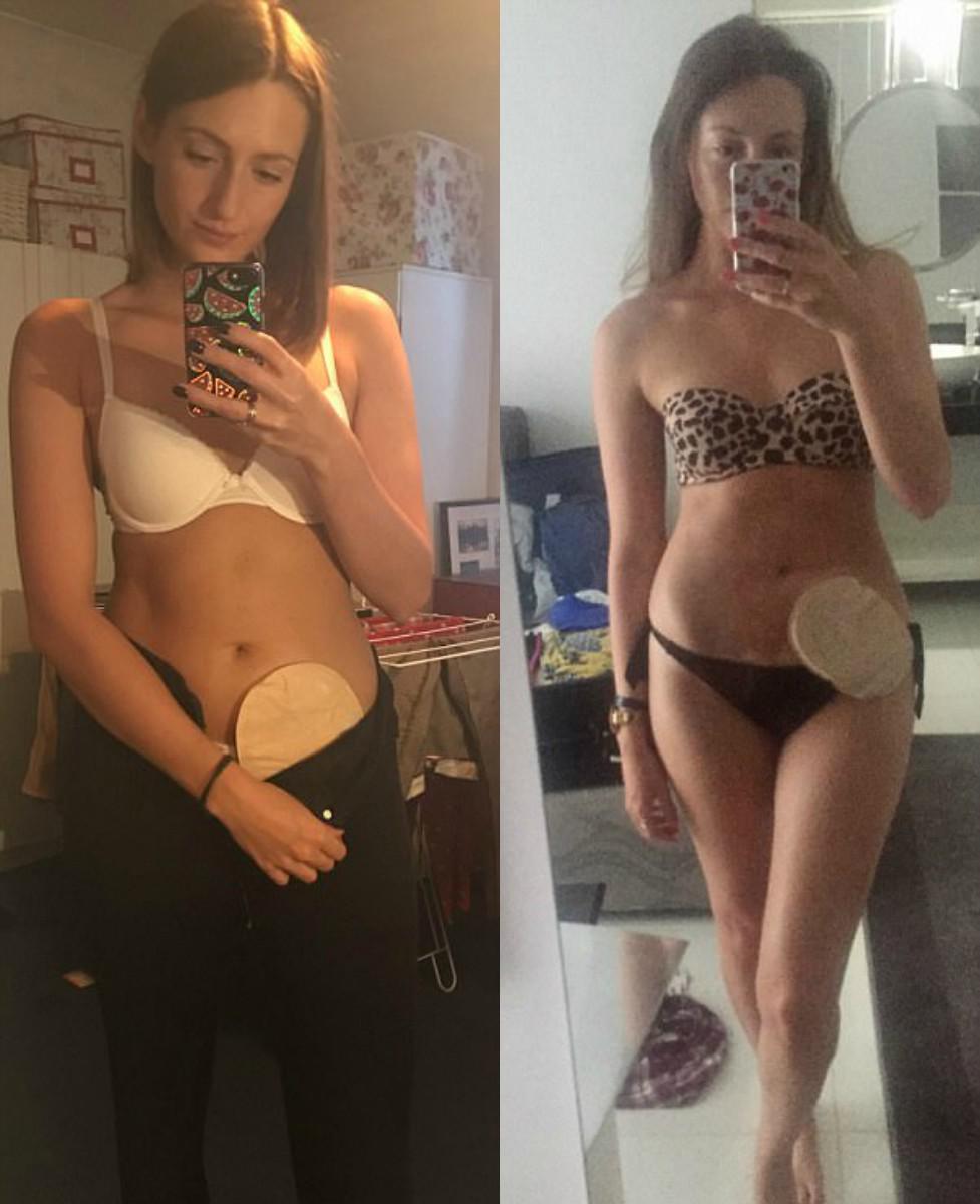 Γυναίκα με νόσο του Bowen ποζάρει υπερήφανα με το σακουλάκι της και δίνει ένα μάθημα ζωής.