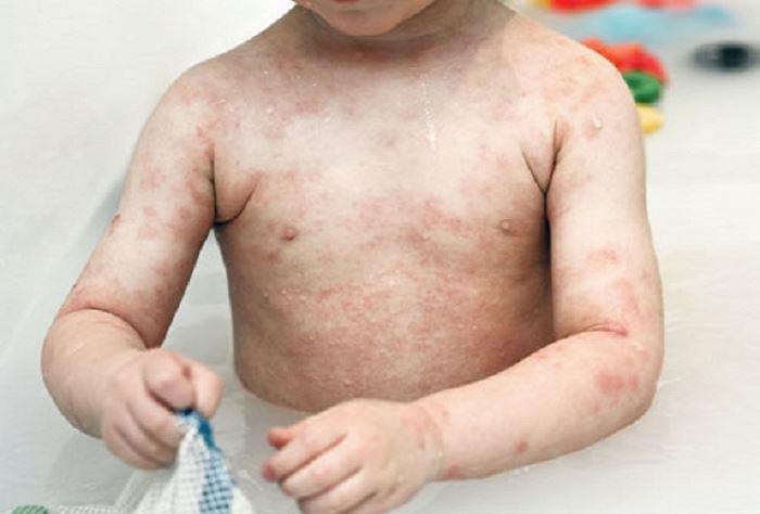 Χρόνια Κοκκιωμαιώδης Νόσος: Η κληρονομική ασθένεια που παρατηρείται κυρίως στα αγόρια και μπορεί να προκαλέσει πνευμονία