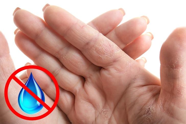 7 Σημάδια στα χέρια που πρέπει να προσέξουμε- Ποιες παθήσεις κρύβονται