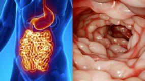 Όσα πρέπει να γνωρίζουμε για τη Νόσο του Crohn (Κρον)- Ποια η διαφορά με την Ελκώδη κολίτιδα