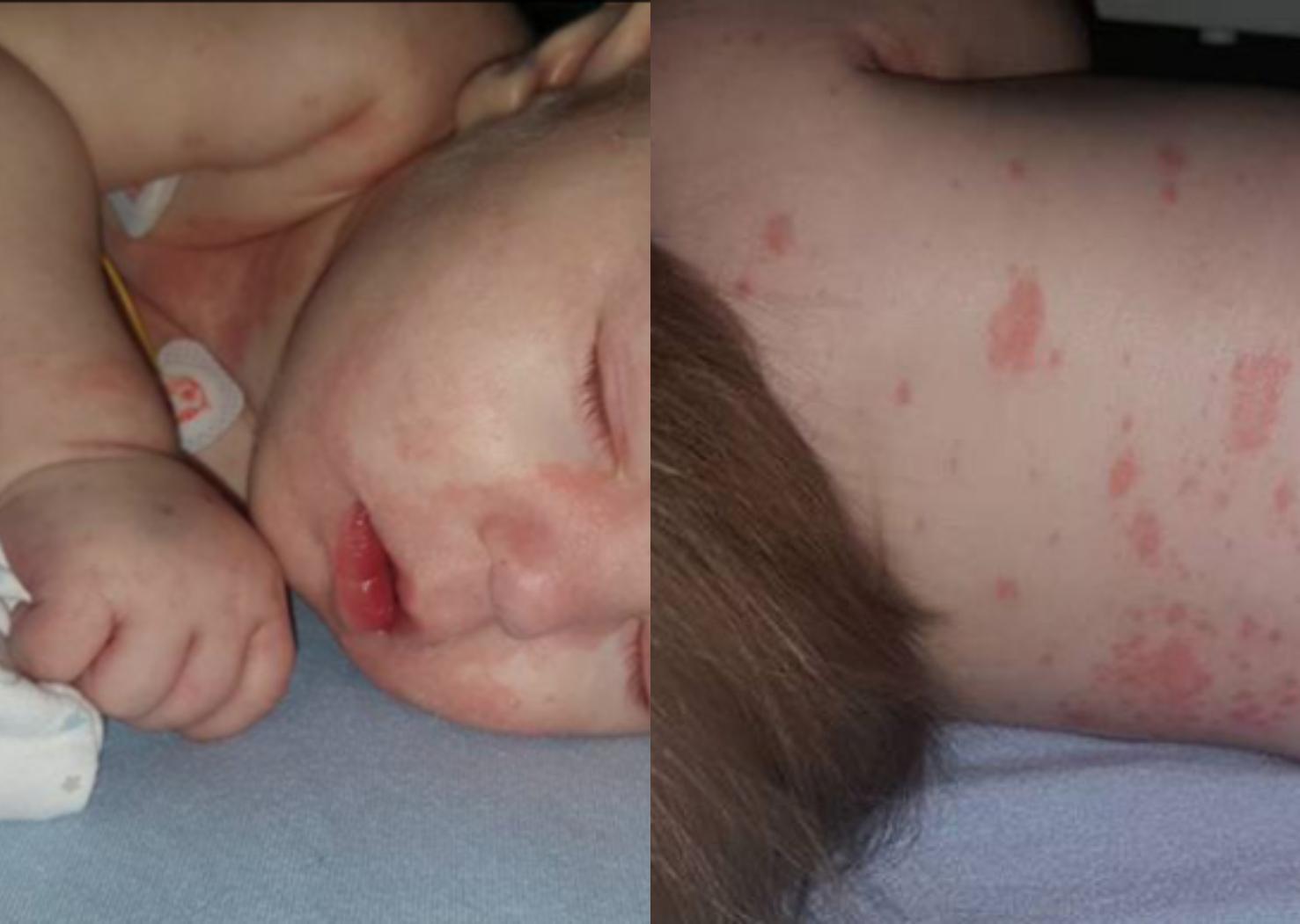 Μηνιγγίτιδα: Τα πιο επικίνδυνα συμπτώματα–Ποιοι πρέπει να εμβολιαστούν άμεσα;