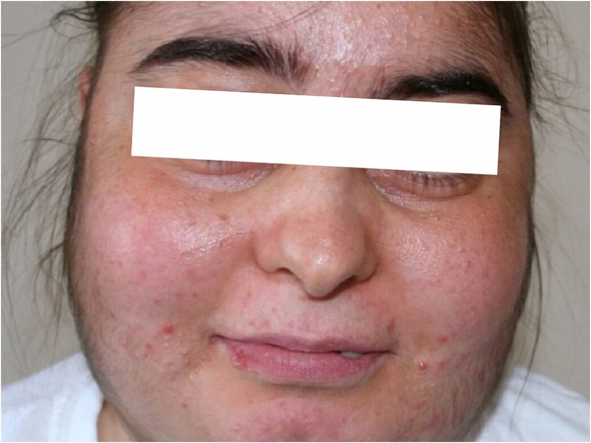 Σύνδρομο Cushing: Η νόσος που διακρίνεται από την αύξηση βάρους και την εύκολη κόπωση- Δείτε όλα τα συμπτώματα